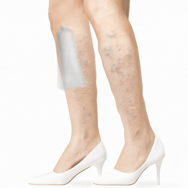 Aplicación y uso de Variquit para el cuidado de las piernas
